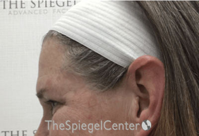 Forehead Contouring Before & After Gallery - Patient 306157 - Image 3