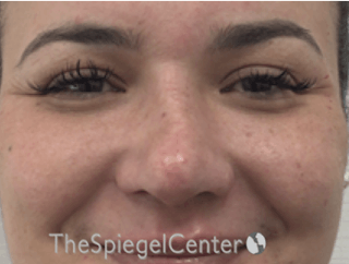 Non-Surgical Rhinoplasty / Nose Filler Before & After Gallery - Patient 190670 - Image 2