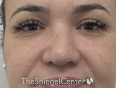 Non-Surgical Rhinoplasty / Nose Filler Before & After Gallery - Patient 190670 - Image 1
