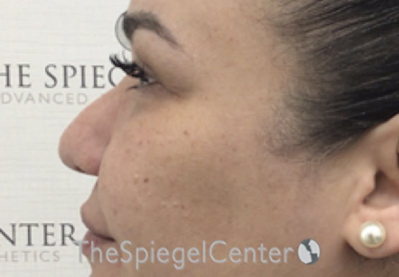 Non-Surgical Rhinoplasty / Nose Filler Before & After Gallery - Patient 190670 - Image 3