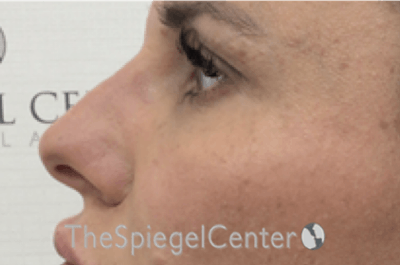 Non-Surgical Rhinoplasty / Nose Filler Before & After Gallery - Patient 338114 - Image 4