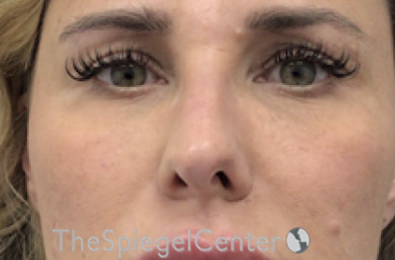 Non-Surgical Rhinoplasty / Nose Filler Before & After Gallery - Patient 338114 - Image 2