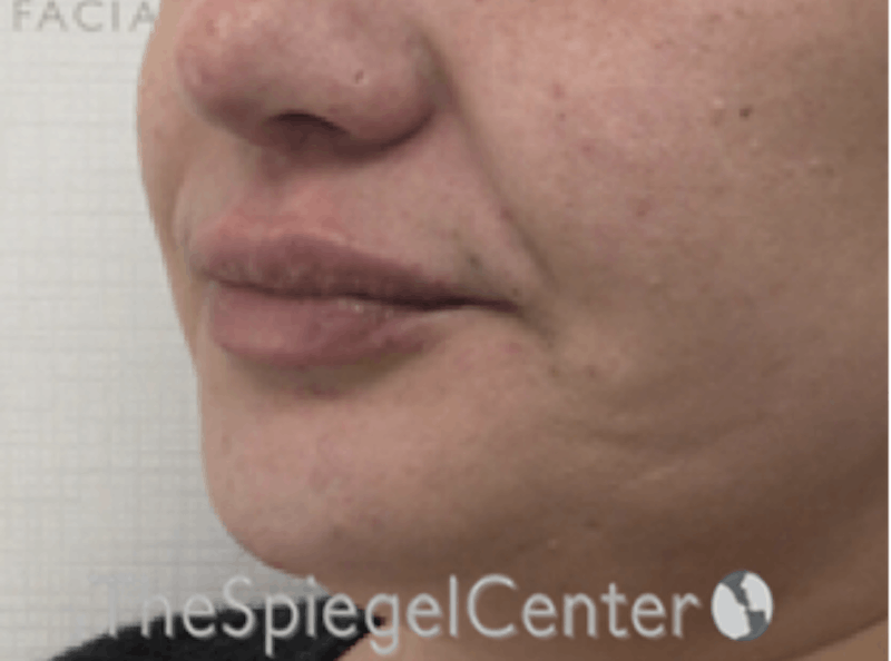 Lip Filler Before & After Gallery - Patient 887293 - Image 6