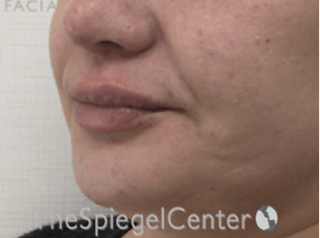 Lip Filler Before & After Gallery - Patient 887293 - Image 6