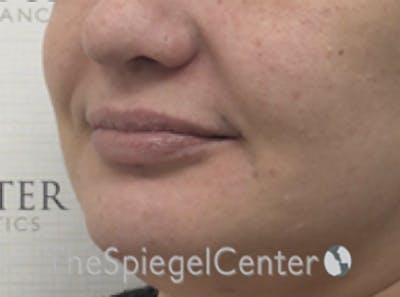 Lip Filler Before & After Gallery - Patient 887293 - Image 5