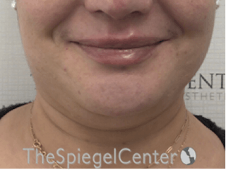 Lip Filler Before & After Gallery - Patient 887293 - Image 4