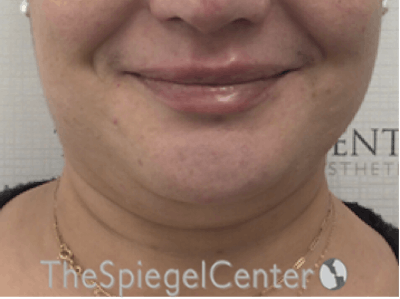 Lip Filler Before & After Gallery - Patient 887293 - Image 4