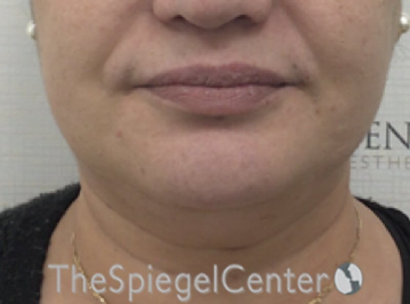 Lip Filler Before & After Gallery - Patient 887293 - Image 3