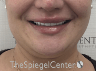 Lip Filler Before & After Gallery - Patient 887293 - Image 2
