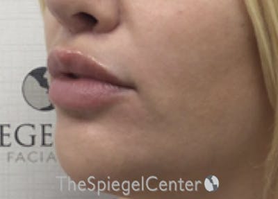 Lip Lift Before & After Gallery - Patient 364118 - Image 4