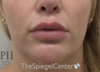 Lip Lift Before & After Gallery - Patient 364118 - Image 1
