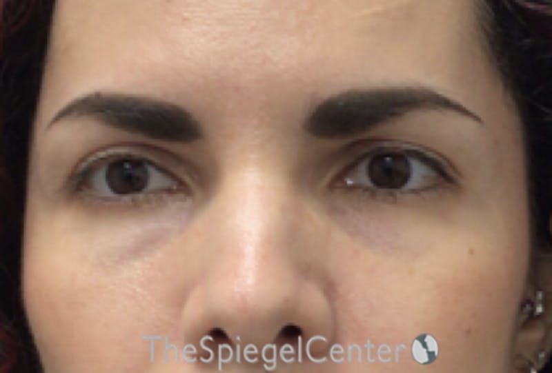 Temple Filler Before & After Gallery - Patient 110928 - Image 2