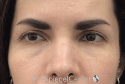Temple Filler Before & After Gallery - Patient 110928 - Image 1