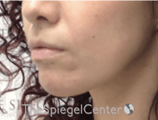 Nasolabial Fold Filler Before & After Gallery - Patient 246760 - Image 4