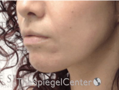Nasolabial Fold Filler Before & After Gallery - Patient 246760 - Image 4
