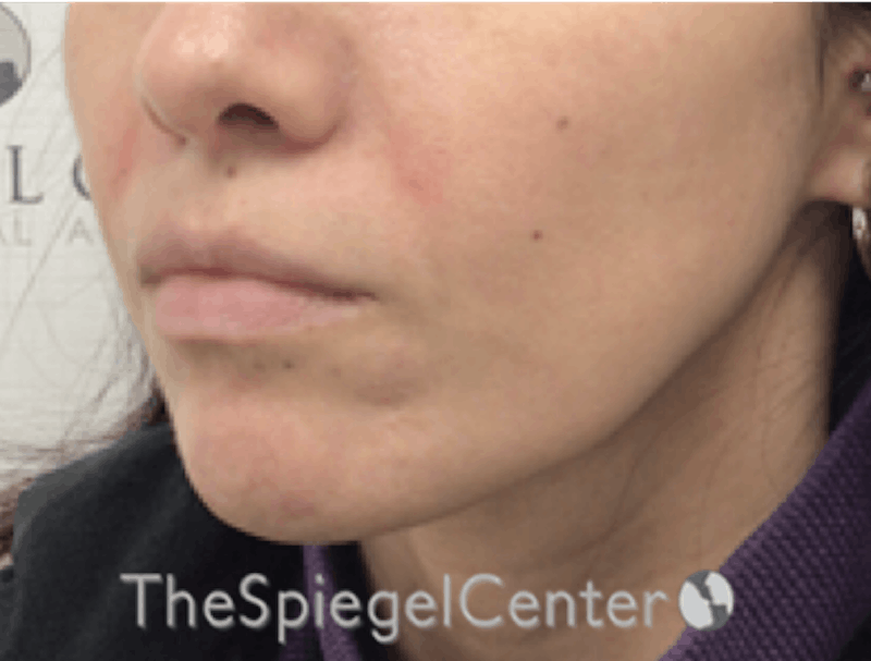 Nasolabial Fold Filler Before & After Gallery - Patient 246760 - Image 3