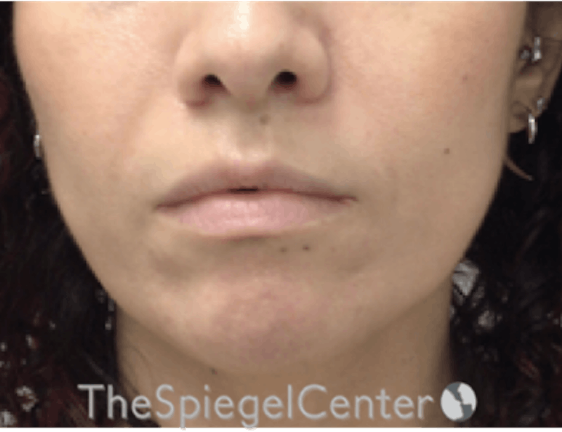 Nasolabial Fold Filler Before & After Gallery - Patient 246760 - Image 2