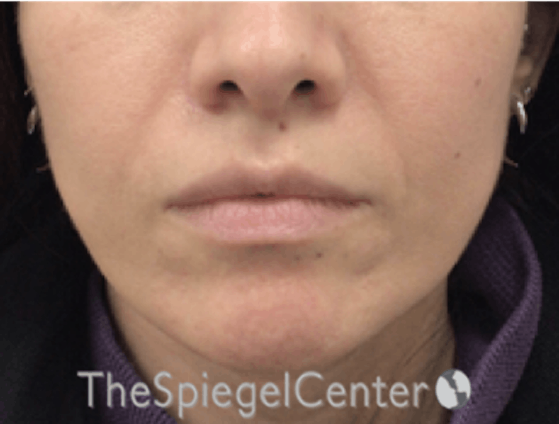 Nasolabial Fold Filler Before & After Gallery - Patient 246760 - Image 1