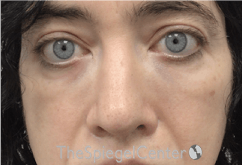 Rhinoplasty Before & After Gallery - Patient 157140434 - Image 4