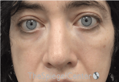 Rhinoplasty Before & After Gallery - Patient 157140434 - Image 4