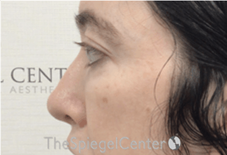 Rhinoplasty Before & After Gallery - Patient 157140434 - Image 2