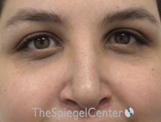 Rhinoplasty Before & After Gallery - Patient 162629951 - Image 4