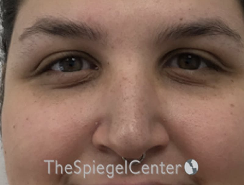 Rhinoplasty Before & After Gallery - Patient 162629951 - Image 3