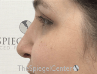 Rhinoplasty Before & After Gallery - Patient 162629951 - Image 2