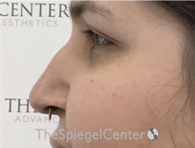 Rhinoplasty Before & After Gallery - Patient 162629951 - Image 1