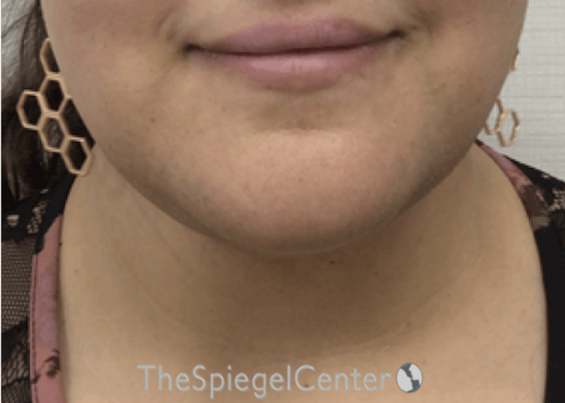Neck Lift Before & After Gallery - Patient 342882 - Image 4