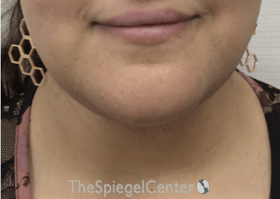 Neck Lift Before & After Gallery - Patient 342882 - Image 4