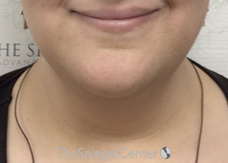 Neck Lift Before & After Gallery - Patient 342882 - Image 3