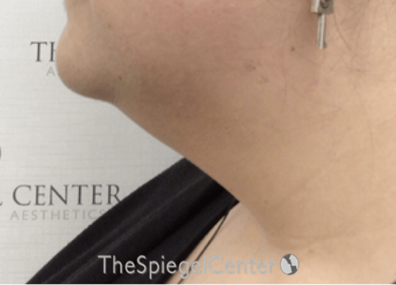 Neck Lift Before & After Gallery - Patient 342882 - Image 1