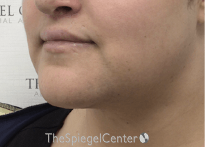 Mandible Contouring Before & After Gallery - Patient 326139 - Image 4