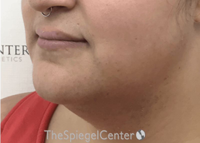 Mandible Contouring Before & After Gallery - Patient 326139 - Image 3