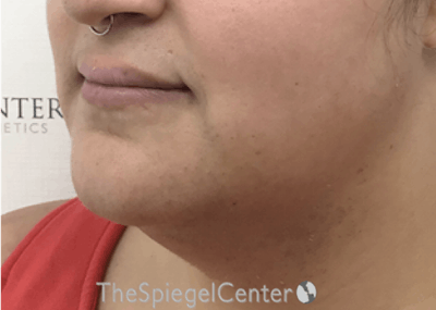 Mandible Contouring Before & After Gallery - Patient 326139 - Image 3