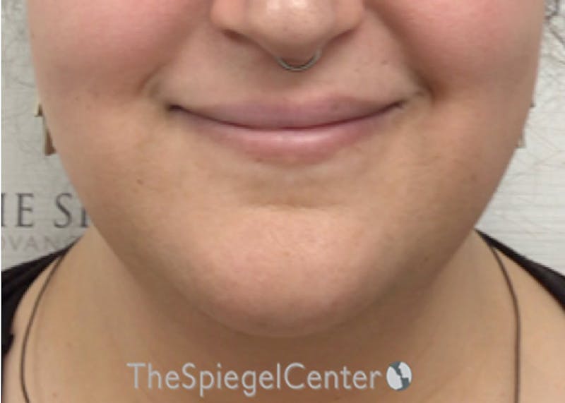 Mandible Contouring Before & After Gallery - Patient 326139 - Image 1