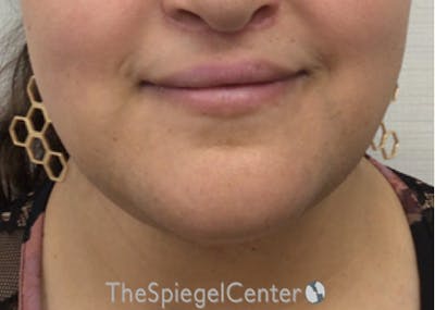 Mandible Contouring Before & After Gallery - Patient 326139 - Image 2