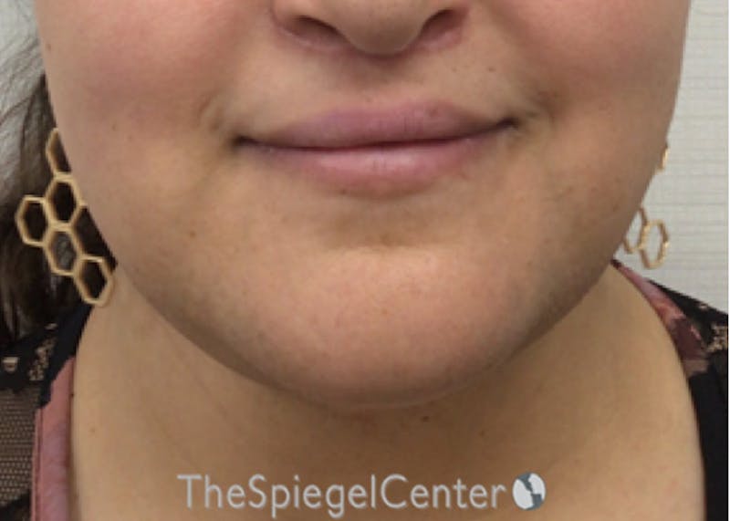Mandible Contouring Before & After Gallery - Patient 326139 - Image 2