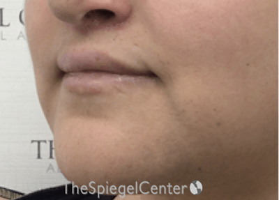 Lip Lift Before & After Gallery - Patient 317975 - Image 4