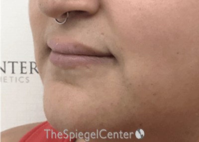Lip Lift Before & After Gallery - Patient 317975 - Image 3