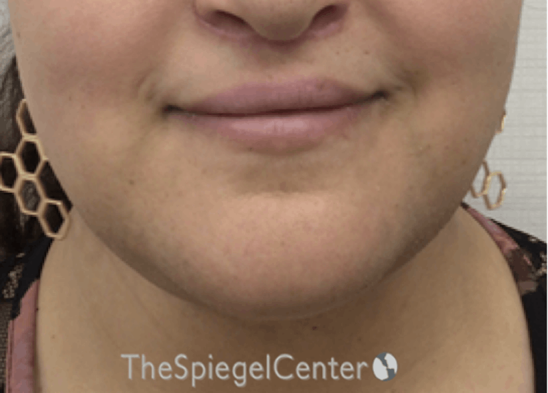 Lip Lift Before & After Gallery - Patient 317975 - Image 2