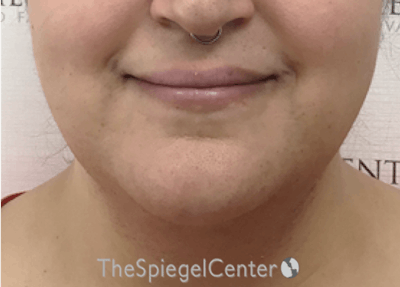 Lip Lift Before & After Gallery - Patient 317975 - Image 1