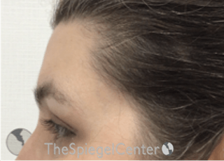 Forehead Contouring Before & After Gallery - Patient 268606 - Image 4