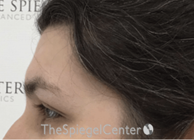 Forehead Contouring Before & After Gallery - Patient 268606 - Image 3