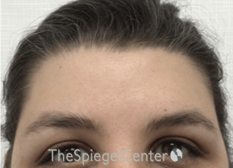 Forehead Contouring Before & After Gallery - Patient 268606 - Image 2