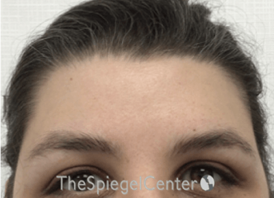 Forehead Contouring Before & After Gallery - Patient 268606 - Image 2