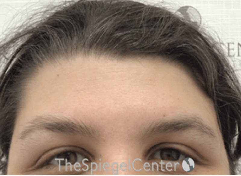 Forehead Contouring Before & After Gallery - Patient 268606 - Image 1