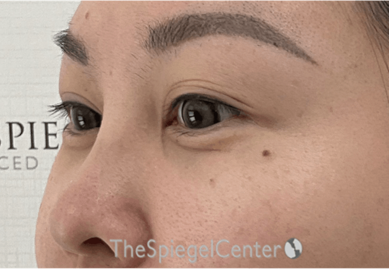 Tear Trough / Under Eye Fillers Before & After Gallery - Patient 405387 - Image 4