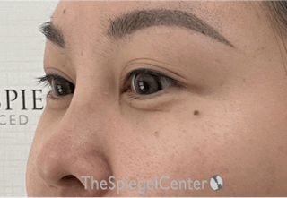 Tear Trough / Under Eye Fillers Before & After Gallery - Patient 405387 - Image 4